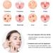 Blackhead Remover Kit Extract Pop and Care for Clear Skin - Acne Comedown Dermatologist Extractor Tool Set for Blemish Facial Skin Care Professional Whitehead Extraction Tweezer Removal - Buy Online on GoSupps.com