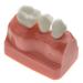 Dental Implant Analysis Demonstration Model - Crown Bridge Teeth Interpretation Model - Buy Online on GoSupps.com