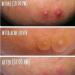 SOME BY MI 30 Days Miracle Clear Spot Patch - 18 Invisible Stickers for Acne & Blemish Care | Sensitive Skin | 10mm 9 Counts 12mm 9 Counts - Buy Online on GoSupps.com