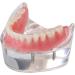 Dental Restore Model with 4 implants implant Demonstration Lower Precision Model Dental Teeth Restoration semi-Covered Prosthesis Decoration - Buy Online on GoSupps.com