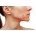 Thursday Plantation Tea Tree Medicated Gel for Acne 25g - Targeted Treatment for Clear Skin - Buy Online on GoSupps.com