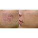 Effective Skin Care Solutions: Cure Acne Psoriasis Sunspots & Scars Shop Internationally - Buy Online on GoSupps.com