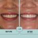 Buy Prostrips: 12 Shades Whiter Teeth - Enamel Safe Remineralizing Strips with 97% No Sensitivity - Fast International Shipping - Buy Online on GoSupps.com