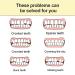 Instant Fake Teeth Dental Veneers for Temporary Tooth Restoration - Upper Jaw Veneers Dentures Socket | Denture Repair Kits - Fix Your Smile At Home! - Buy Online on GoSupps.com