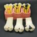 Samnuerly 4-fold dental teeth caries model removable caries evolutionary display tools for dental training materials tooth pathology display
