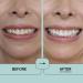Buy Prostrips: 12 Shades Whiter Teeth - Enamel Safe Remineralizing Strips with 97% No Sensitivity - Fast International Shipping - Buy Online on GoSupps.com