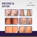 REJUVENON Silicone Scar Sheets - 6 Count for Removal & Healing of C-Section, Surgical, Acne, Burns, Tummy Tuck, Keloid Scars - Buy Online on GoSupps.com