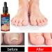 Ingrown Toenail Treatment Correction Drops Nail Growth Treatment Nail Care Ingrowing Toenail Treatment Ingrown Toenail Corrector Treatment for Ingrown Toenail Ingrowing Toenail Improve Toenail Health - Buy Online on GoSupps.com