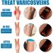 3 Pieces VeinHealing Varicose Vein Spray - Remove Varicose & Spider Veins Soothing Treatment for Legs 30ml | Improve Blood Circulation - Buy Online on GoSupps.com