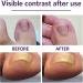 Grgowe Nail Correction Ingrown Toenail Corrector Foot Toenail Plasters Foot Correction Foot Toenail Correction for Care of Toenail Treatment Protect - Buy Online on GoSupps.com