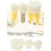 Buy Implant Model 4-Fold Removable Bridge for Dental Training - International Shipping Available - Buy Online on GoSupps.com