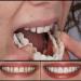 Provisional Dentures | Immediate Smile Teeth Prosthesis | Temporary Upper & Lower Cosmetic Veneers for Bad Teeth - Buy Online on GoSupps.com