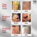 Scar Logic Advanced Treatment Cream for Face & Body | Scar Remover for Acne, Surgical, Stretch Mark & Burn Scars | Nourishing Biologicals (20ml) - Buy Online on GoSupps.com