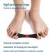 2023 Updated Toe Corrector Set - Bunion Splint & Toe Separator for Hallux Valgus - Orthopedic Bunion Brace with Exercise Strap - Pain Relief Kit (Free Black) - Buy Online on GoSupps.com