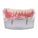 Dental Teeth Model - Lower Removable Overdenture with 2 Implants | Dentist Assistant Supplies - International Shipping - Buy Online on GoSupps.com