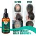 Hair Growth Serum with Ginger Oil - Anti-Hair Loss Thickening & Quick Growth - 30ml for Thinner Hair - Buy Online on GoSupps.com