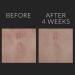Kate Somerville D-Scar Scar Diminishing Serum - Acne Scar Treatment - 0.66 Fl Oz - Buy Online on GoSupps.com