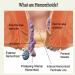 GDSAFS Heca Natural Herbal Strength Hemorrhoid Capsules - Relief from Discomfort (1 Box) - Buy Online on GoSupps.com