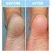 BODIPURE Premium Keratin Gloves & Socks - Hydrating Dull Dry Hands, Cracked Heels, Softens Calluses, Strengthens Nails, Brightens & Nourishes Skin - 3+3 Pack - Buy Online on GoSupps.com