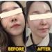 BNY Miracle Facial Peel 1.76 fl oz Mat Na Peel Da Sinh Hoc - Buy Online on GoSupps.com
