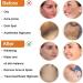 EVNI 2023 Skinenjoy Cleansing Lotion for Acne, Spots & Acanthosis Nigricans - Dark Spot Remover 50ml - Buy Online on GoSupps.com