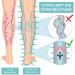 Venenwalker Pro2 Vein Therapy | Certified Medical Device for Venous Issues | Fast Relief for Thigh Problems - Buy Online on GoSupps.com