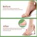 Metatarsal Pads for Women | Non-Slip Forefoot Inserts & Cushion for High Heels | Pain Relief Soft Foot Pads - 3 Pairs (Transparent Light Yellow Black - Buy Online on GoSupps.com