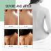 Effective Back Acne Treatment Herbal Spray - 2023 New Formula for Back & Chest (1pcs) | Shop Internationally - Buy Online on GoSupps.com