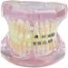Luceae dental orthodontic demonstration model orthodontic retainer treatment model for dentures with self-ligating metal clamps that explain the model