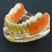 Dental Implant Restoration Model | Removable Bridge & Denture Demo for Teaching & Patient Education - Buy Online on GoSupps.com