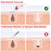 2023 Blackhead Remover Pore Vacuum - Upgraded Electric Facial Cleaner with 5 Suction Power Probes - USB Rechargeable Blackhead Vacuum Kit for Women & Men - Buy Online on GoSupps.com