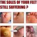 SHWORON G OU Extra Strength Foot Corn Removal Gel - 1PCS - Buy Online on GoSupps.com