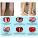 18Pcs Pat Varicose Veins Treatment Plasters - Herbal Medicine for Spider Veins & Vasculitis - Effective Chinese Remedies - Buy Online on GoSupps.com