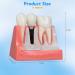 Dental Implant Model - 4 Times Removable Crown Bridge | Educational Teeth Model for Learning & Analysis - Buy Online on GoSupps.com