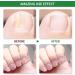 Fungal Nail Treatment - Extra Strong Nail Fungus Treatment for Toenail and Fingernail - Anti fungus Nail Repair and Strengthen Fix & Renew Damaged Broken Nails Restoring Healthy Nails-30ml - Buy Online on GoSupps.com