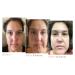 Sonage Zitlox Salicylic Acne Gel - Effective Spot Treatment with Tea Tree Oil | Clear Blemishes & Benzoyl Peroxide Alternative | International Shipping Available - Buy Online on GoSupps.com