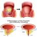 Hhkuize Heca Natural Herbal Hemorrhoid Capsules - Fast Relief (2 Box) - Buy Online on GoSupps.com