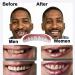 WGTCzy Cosmetic Veneer Temporary Denture Teeth Natural Look Snap-On Comfort for Men & Women | Immediate Solution for Bad Teeth (4 Pairs) - Buy Online on GoSupps.com