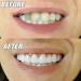 Dazluxe 2 Pairs Dentures - Cosmetic Veneers & Temporary Artificial Teeth for Men & Women | Boost Your Confident Smile - Buy Online on GoSupps.com