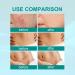 Scar Removal Advanced Spray - 2PCS (20g) | Remove Dark Acne, Surgical Scars & Stretch Marks - Buy Online on GoSupps.com