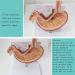 Educational Model Simulated Human Stomach Anatomy Model Diseased Stomach Model Stomach Disease Demonstration Model Pathological Stomach Model Medical Models - Buy Online on GoSupps.com
