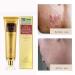 Symeas Scar & Acne Removal Cream - Effective Treatment for Stretch Marks Keloid Skin & Burns - 30g - Buy Online on GoSupps.com