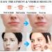 Zemolo 600pcs Pimple Patch Hydrocolloid Acne Stickers with Tea Tree Oil & Salicylic Acid - Day & Night Acne Absorbing Patches for Pimples and Whiteheads - Buy Online on GoSupps.com