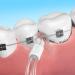 Arspic Flosser Replacement Tips for Water Flossers - Orthodontic Braces Cleaning Tips (4-Pack) - Buy Online on GoSupps.com
