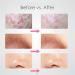 Acne Needle 7pcs Tool Black Spots Needles Pore Cleanser Vacum Comedone Pimple Blemish Extractor Beauty Tools (Color : 8PCS GJ5061) - Buy Online on GoSupps.com