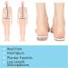 Adjustable Orthopedic Heel Lift Inserts 14-1 Gel Pads for Height Increase & Pain Relief - 4-Layer Insole for Leg Discrepancies, Heel Spurs, Sports Injuries - Small Size - Buy Online on GoSupps.com