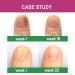 Extra Strength Toenail Fungus Treatment - Nail Repair Solution for Discolored Nails - Renew Damaged Toenails - Fingernail & Toenail Fungus Treatment - Buy Online on GoSupps.com