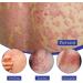 Mandurs South Moon Psoriasis Repair Spray - Herbal Treatment for Skin with Youth Bee Venom Cream (1pcs) - Buy Online on GoSupps.com