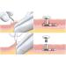 Disposable Sterile Biopsy Punch - 5mm Stainless Steel Dermal Piercing Tool | Safe Skin Punch for Accurate Biopsies | 1pc - Buy Online on GoSupps.com