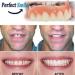 Adjustable Snap-On Dentures for Men - Eat, Smile & Cover Imperfections Instantly - Top & Bottom Set of Temporary Fake Teeth for Confidence Boost - Buy Online on GoSupps.com